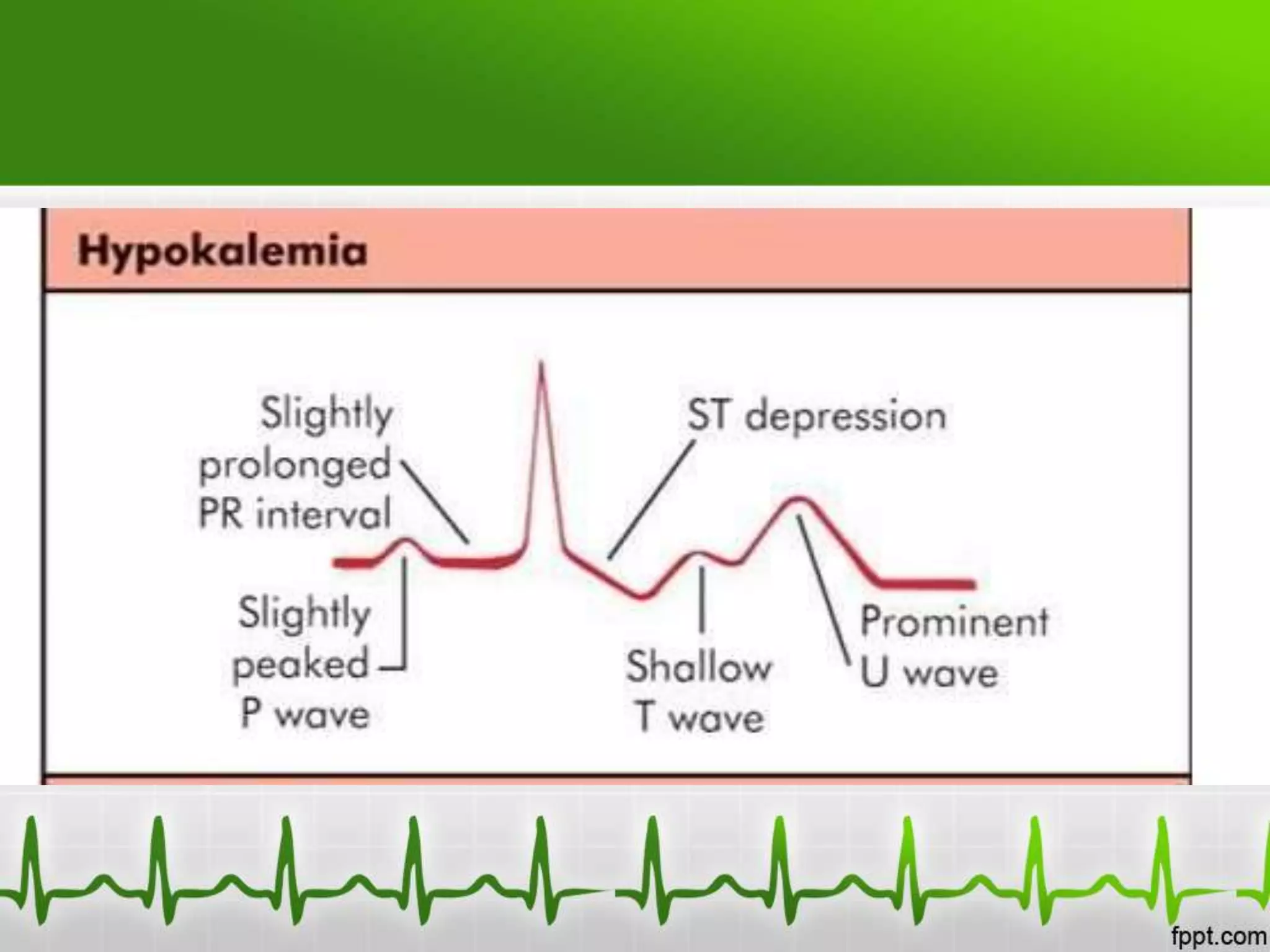 Electrolyte And Metabolic Ecg Abnormalities Pptx