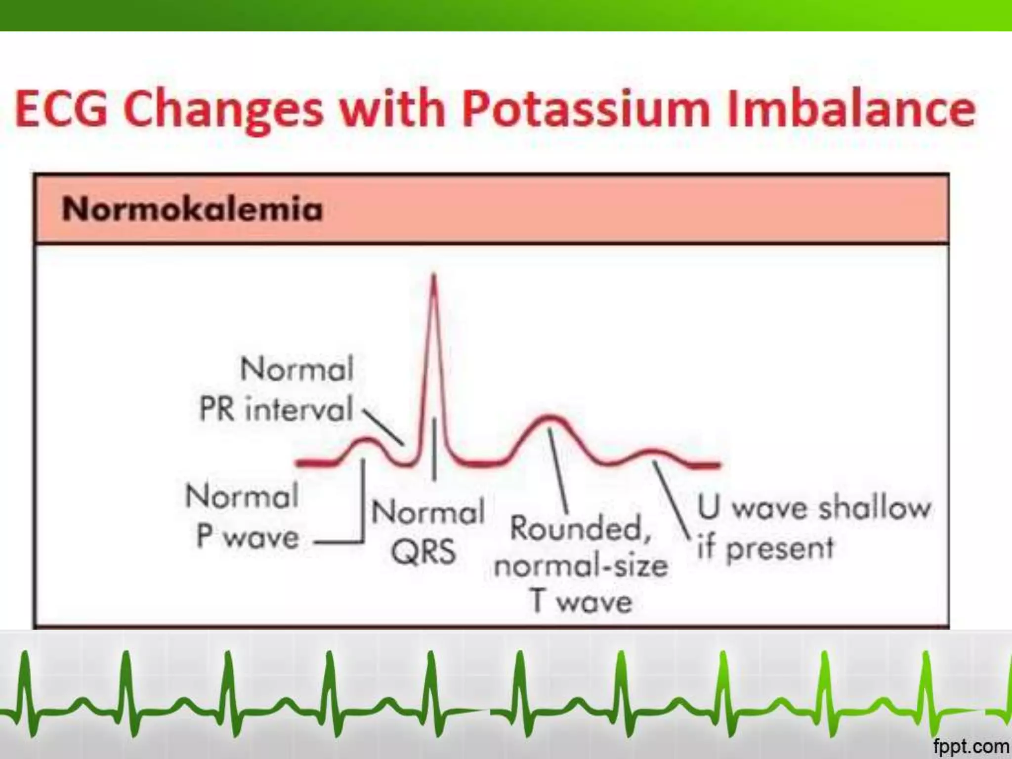 Electrolyte And Metabolic Ecg Abnormalities Pptx