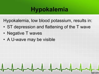 Hypokalemia
Hypokalemia, low blood potassium, results in:
• ST depression and flattening of the T wave
• Negative T waves
• A U-wave may be visible
 