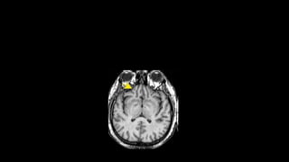 MRI
(MAGNETIC RESONACE IMAGING)
Uses Short wave radio waves with a
magnet to create an image.
 