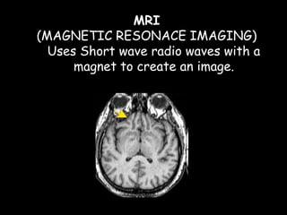 MRI
(MAGNETIC RESONACE IMAGING)
Uses Short wave radio waves with a
magnet to create an image.
 