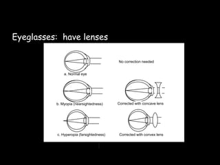 Eyeglasses: have lenses
c. Hyperopia (farsightedness)
a. Normal eye
b. Myopia (nearsightedness) Corrected with concave lens
Corrected with convex lens
No correction needed
 
