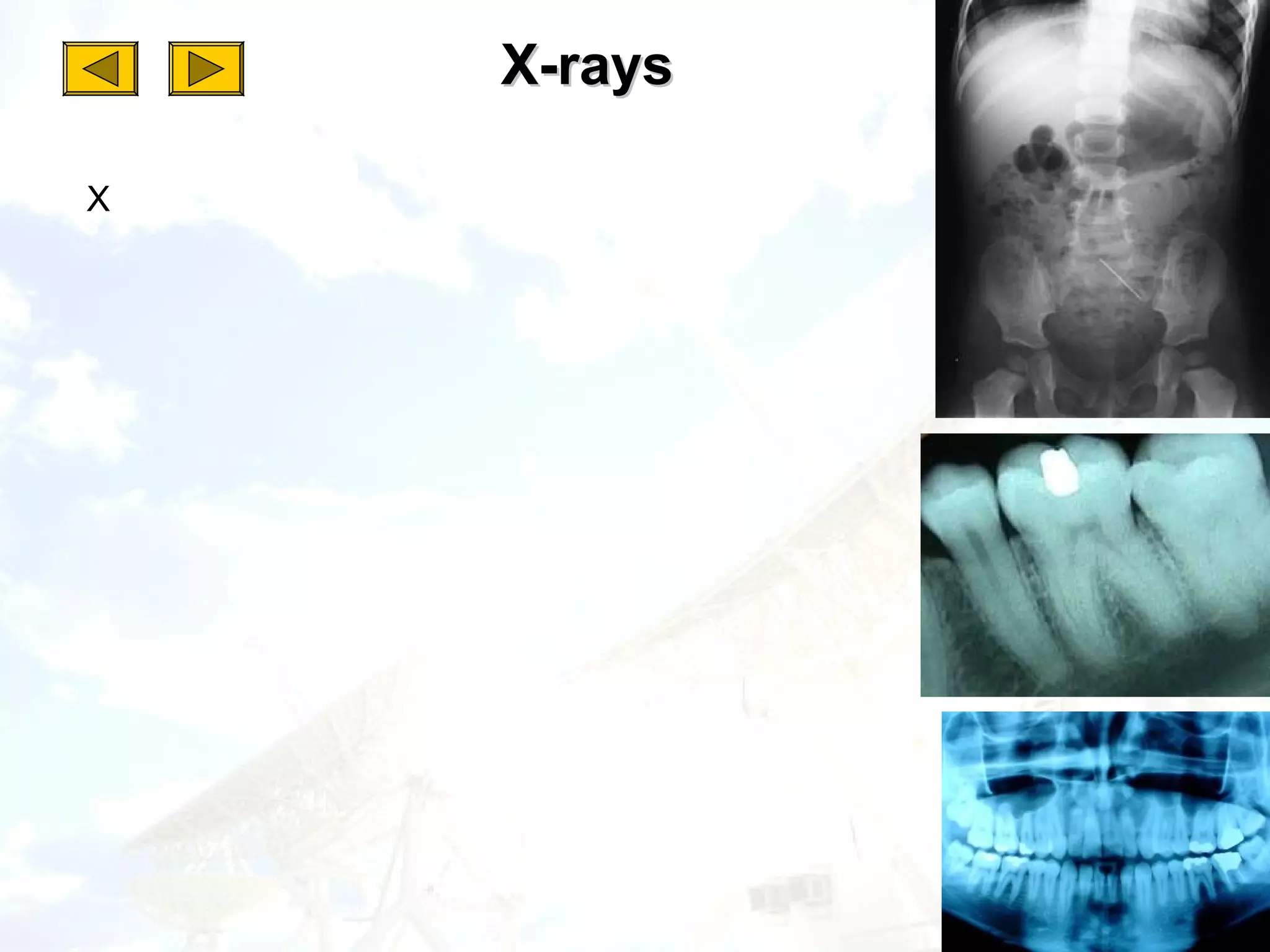 X-rays

X
 