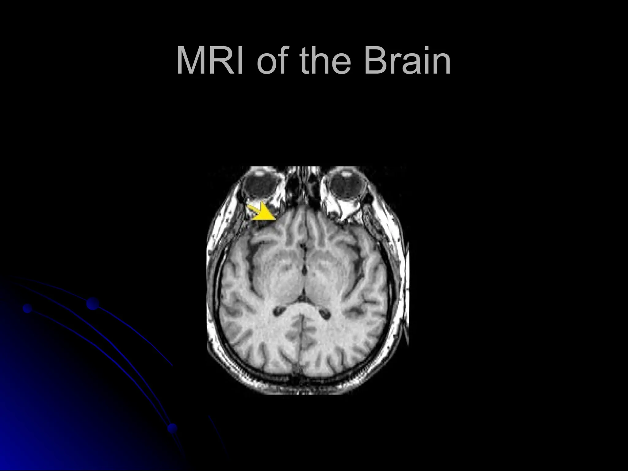 MRI of the Brain
MRI of the Brain
 