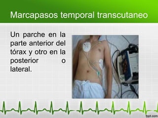 Marcapasos temporal transcutaneo
Un parche en la
parte anterior del
tórax y otro en la
posterior o
lateral.
 