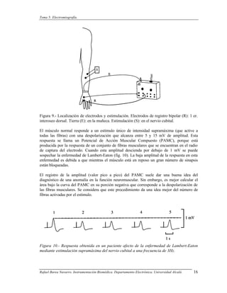 Tema 5: Electromiografía.




Figura 9.- Localización de electrodos y estimulación. Electrodos de registro bipolar (R): 1 er.
interoseo dorsaI. Tierra (E): en la muñeca. Estimulación (S): en el nervio cubital.

El músculo normal responde a un estímulo único de intensidad supramáxima (que active a
todas las fibras) con una despolarización que alcanza entre 5 y 15 mV de amplitud. Esta
respuesta se llama un Potencial de Acción Muscular Compuesto (PAMC), porque está
producida por la respuesta de un conjunto de fibras musculares que se encuentran en el radio
de captura del electrodo. Cuando esta amplitud descienda por debajo de 1 mV se puede
sospechar la enfermedad de Lambert-Eaton (fig. 10). La baja amplitud de la respuesta en esta
enfermedad es debida a que mientras el músculo está en reposo un gran número de sinapsis
están bloqueadas.

El registro de la amplitud (valor pico a pico) del PAMC suele dar una buena idea del
diagnóstico de una anomalía en la función neuromuscular. Sin embargo, es mejor calcular el
área bajo la curva del PAMC en su porción negativa que corresponde a la despolarización de
las fibras musculares. Se considera que este procedimiento da una idea mejor del número de
fibras activadas por el estímulo.




Figura 10.- Respuesta obtenida en un paciente afecto de la enfermedad de Lambert-Eaton
mediante estimulación supramáxima del nervio cubital a una frecuencia de 3Hz.




Rafael Barea Navarro. Instrumentación Biomédica. Departamento Electrónica. Universidad Alcalá.   16
 