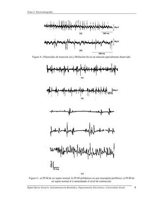 Tema 5: Electromiografía.




    Figura 4.- Potenciales de inserción (a) y fibrilación (b) en un músculo parcialmente denervado.




 Figura 5.- a) PUM de un sujeto normal; b) PUM polifásicos en una neuropatía periférica; c) PUM de
                     un sujeto normal al ir aumentando el nivel de contracción.

Rafael Barea Navarro. Instrumentación Biomédica. Departamento Electrónica. Universidad Alcalá.        8
 