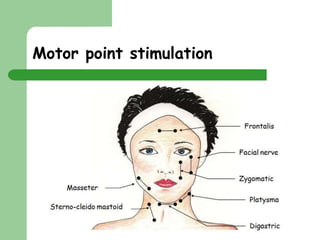 Clare Hargreaves-Norris 
Motor point stimulation 
 
