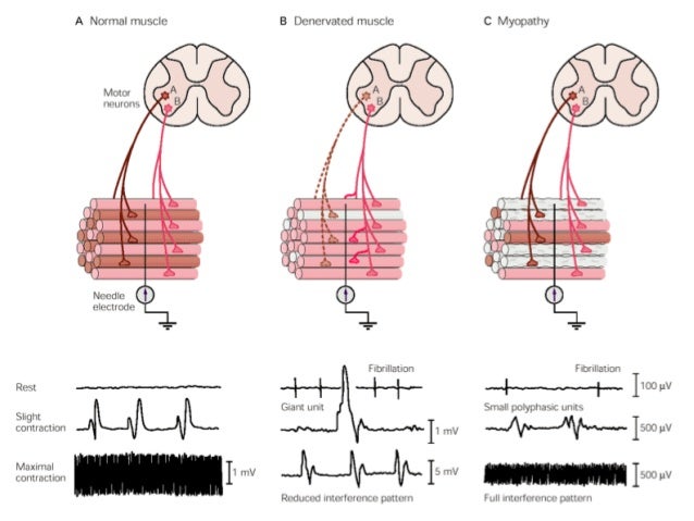 electromyography electromyography