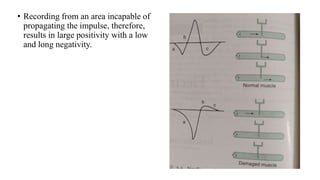 • Recording from an area incapable of
propagating the impulse, therefore,
results in large positivity with a low
and long negativity.
 