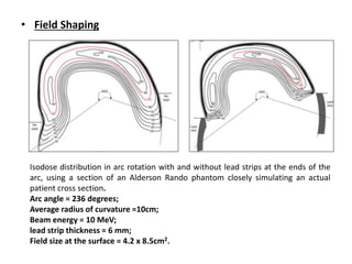 Electron arc therapy | PPTX