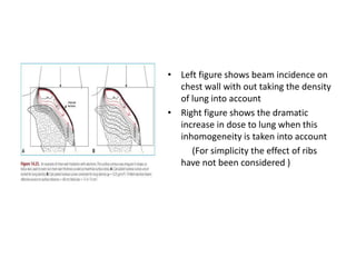 • Left figure shows beam incidence on
chest wall with out taking the density
of lung into account
• Right figure shows the dramatic
increase in dose to lung when this
inhomogeneity is taken into account
(For simplicity the effect of ribs
have not been considered )
 