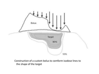 Construction of a custom bolus to comform isodose lines to
the shape of the target
 