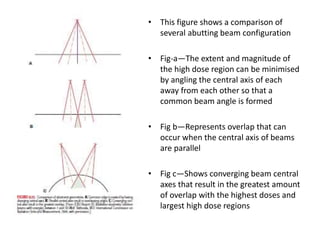 • This figure shows a comparison of
several abutting beam configuration
• Fig-a—The extent and magnitude of
the high dose region can be minimised
by angling the central axis of each
away from each other so that a
common beam angle is formed
• Fig b—Represents overlap that can
occur when the central axis of beams
are parallel
• Fig c—Shows converging beam central
axes that result in the greatest amount
of overlap with the highest doses and
largest high dose regions
 