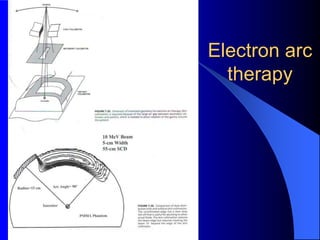 Electron arc
therapy
 