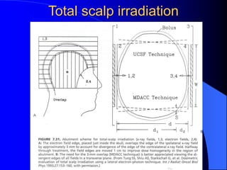 Total scalp irradiation
 