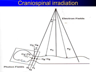 Craniospinal irradiation
 