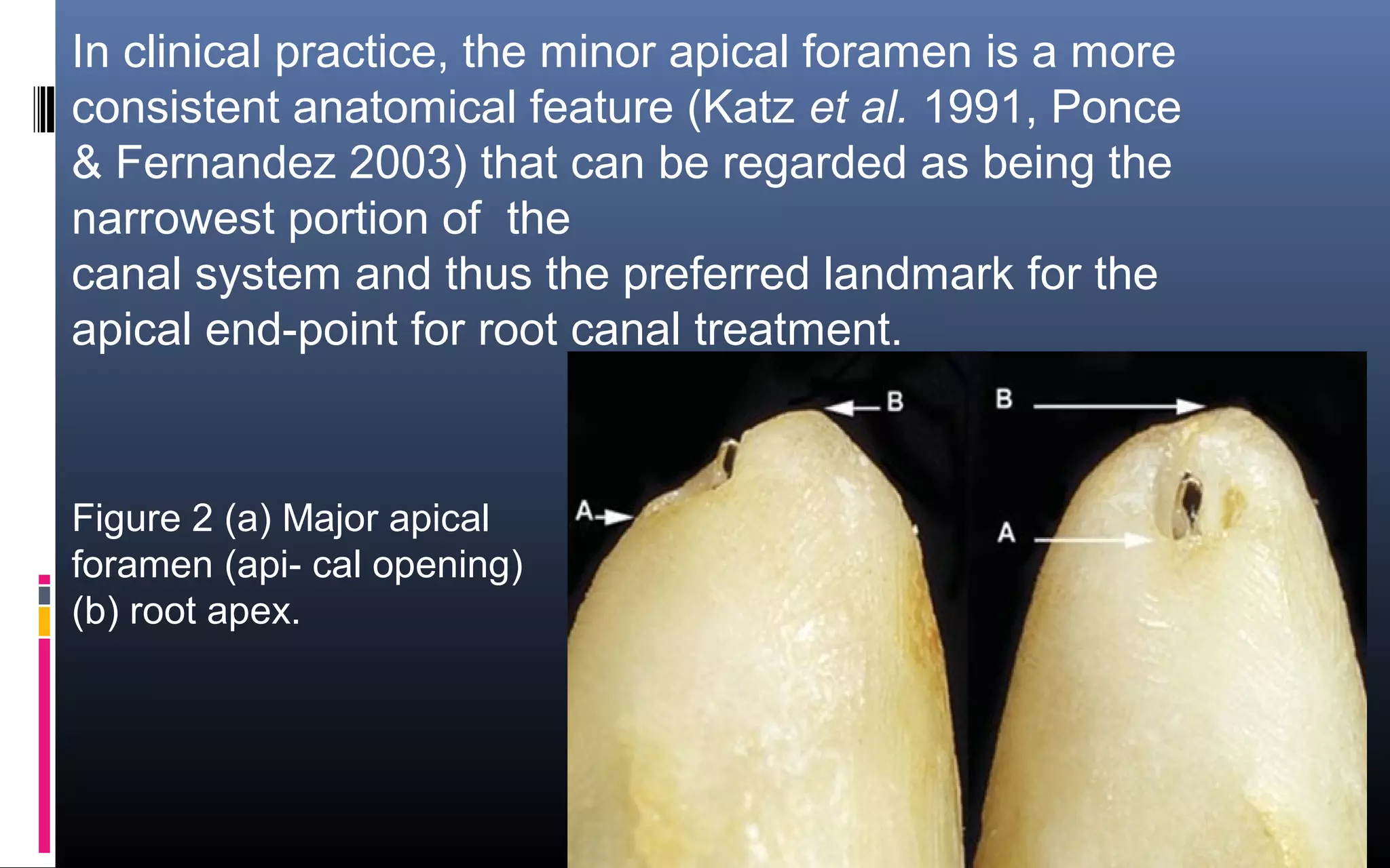 In clinical practice, the minor apical foramen is a more 
consistent anatomical feature (Katz et al. 1991, Ponce 
& Fernandez 2003) that can be regarded as being the 
narrowest portion of  the
canal system and thus the preferred landmark for the 
apical end-point for root canal treatment.
 
Figure 2 (a) Major apical 
foramen (api- cal opening)  
(b) root apex.
 