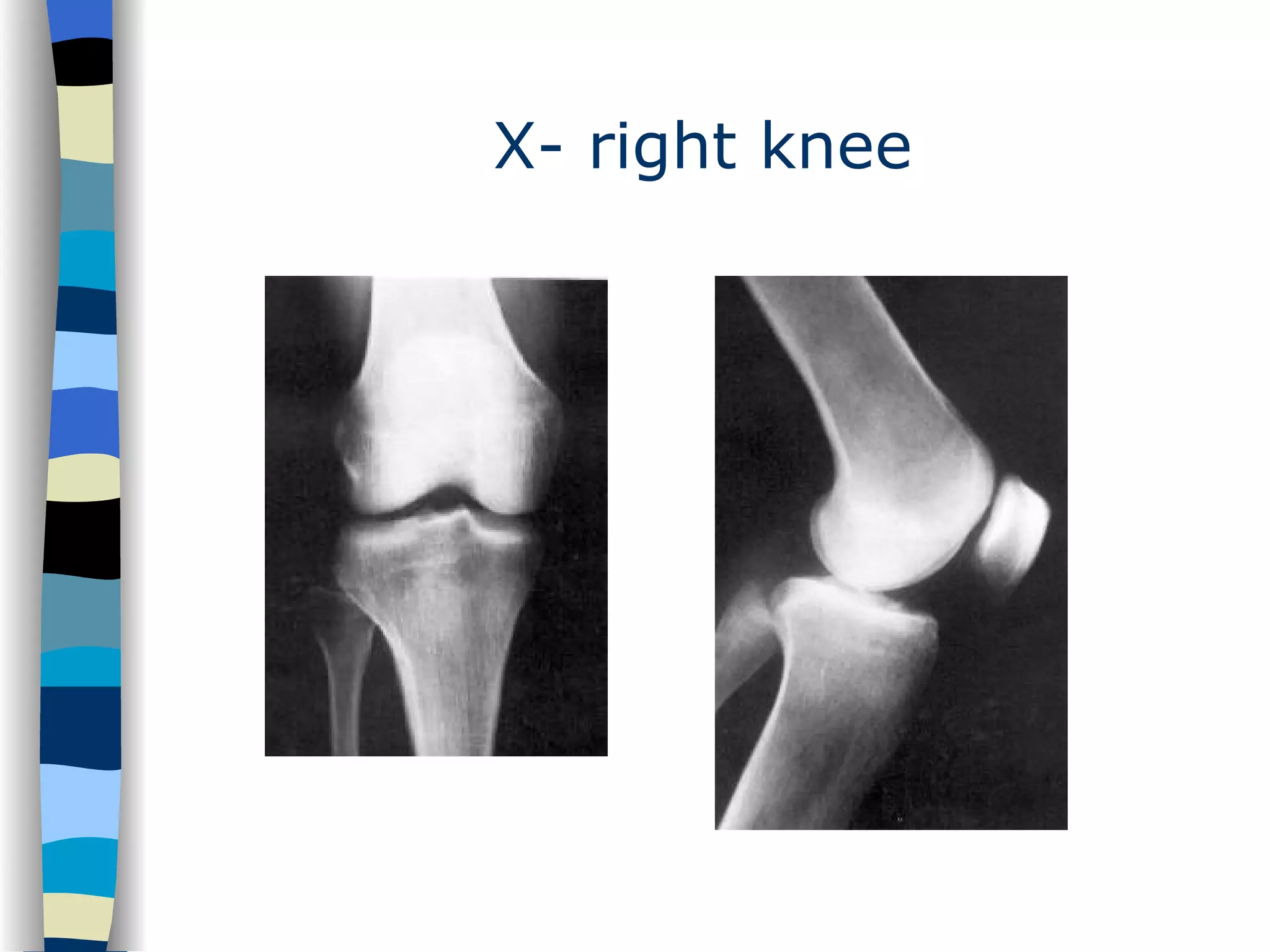 X- right knee 