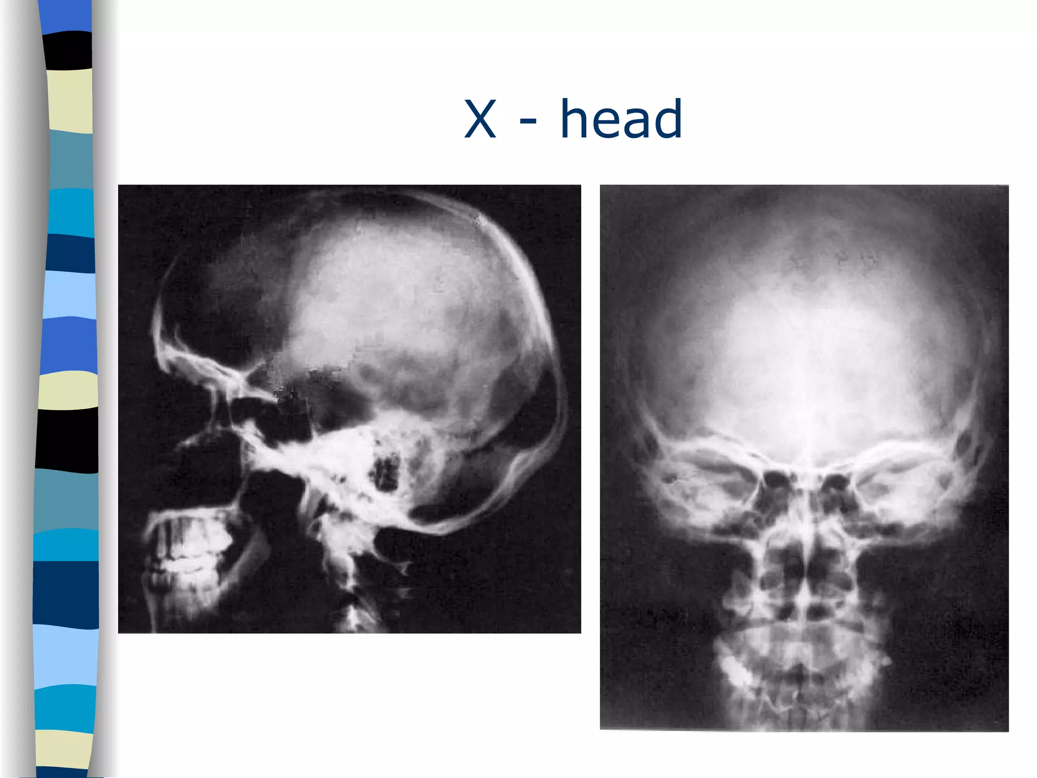 X - head 