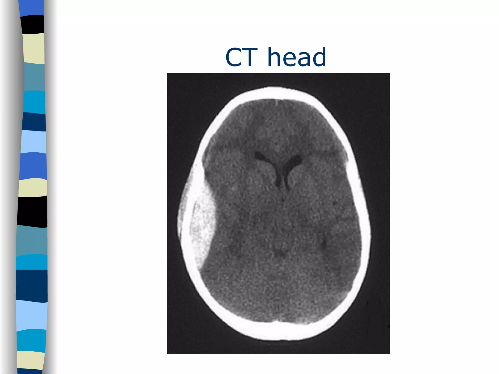 CT head 