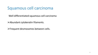 Squamous cell carcinoma
Well differentiated squamous cell carcinoma
Abundant cytokeratin filaments.
Frequent desmosomes between cells.
37
 