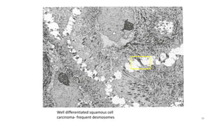Well differentiated squamous cell
carcinoma- frequent desmosomes 38
 