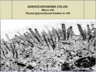 ADENOCARCINOMA COLON
Micro villi
Round glycocalyceal bodies in villi
 