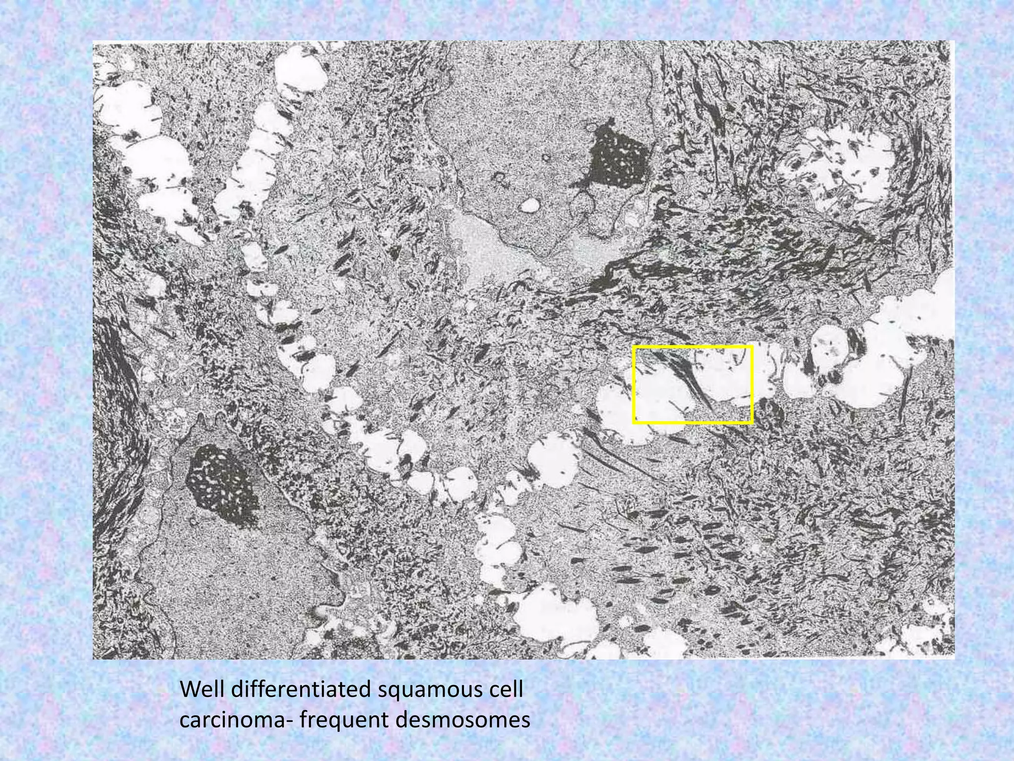 Well differentiated squamous cell
carcinoma- frequent desmosomes
 