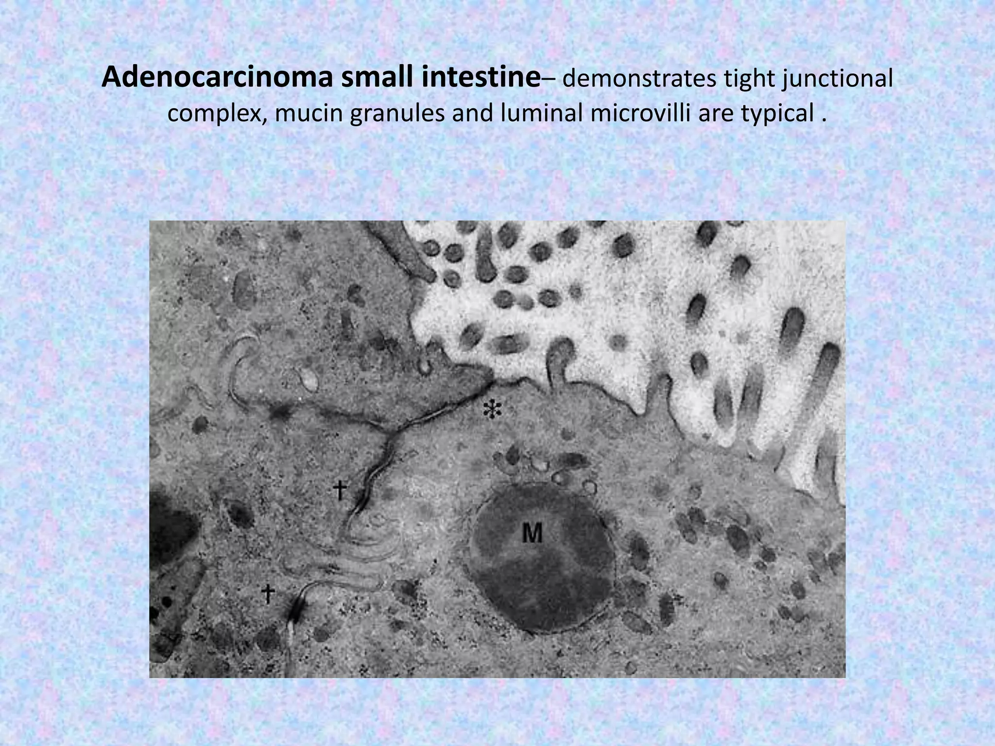 Adenocarcinoma small intestine– demonstrates tight junctional
     complex, mucin granules and luminal microvilli are typical .
 