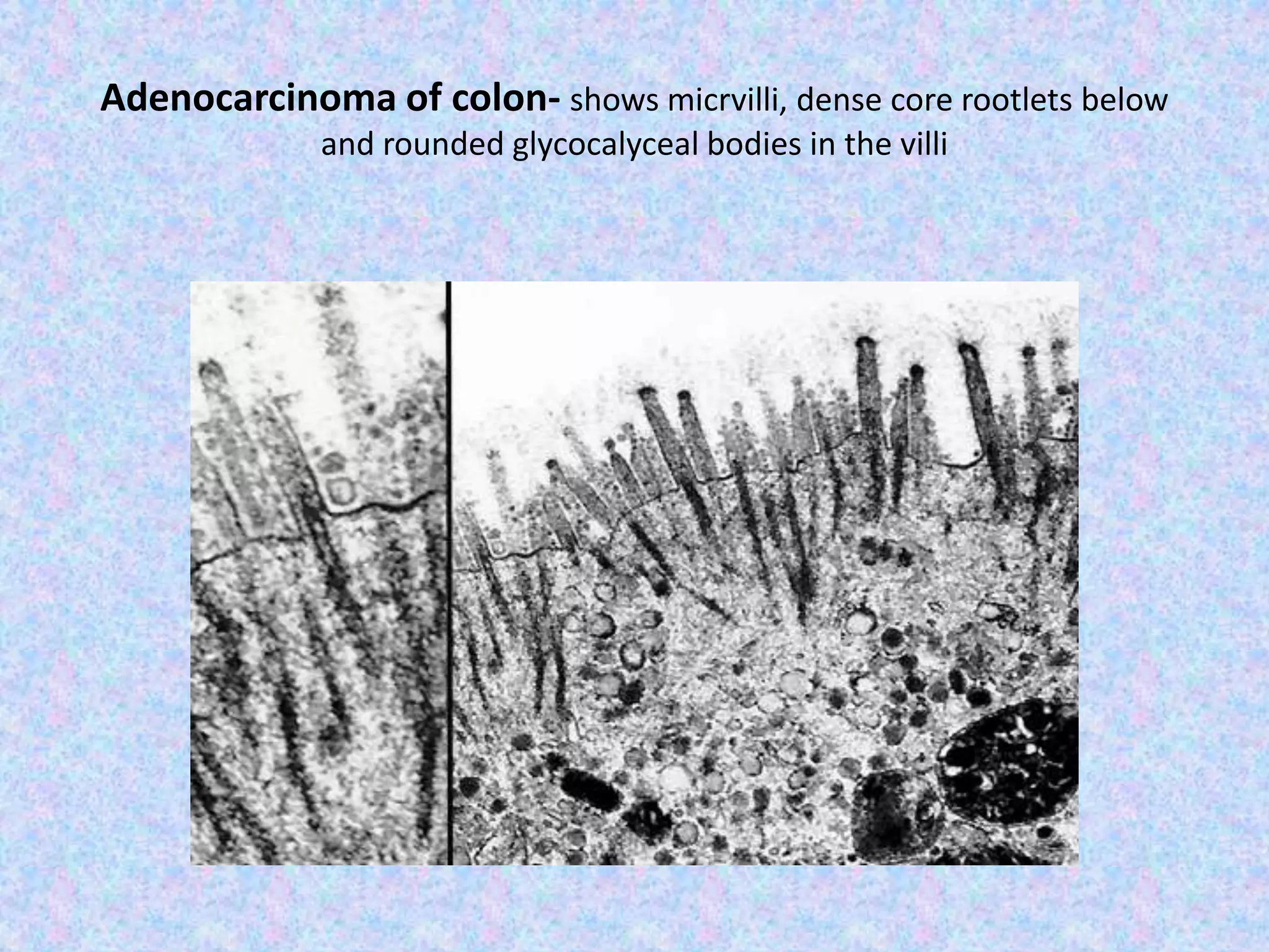 Adenocarcinoma of colon- shows micrvilli, dense core rootlets below
             and rounded glycocalyceal bodies in the villi
 