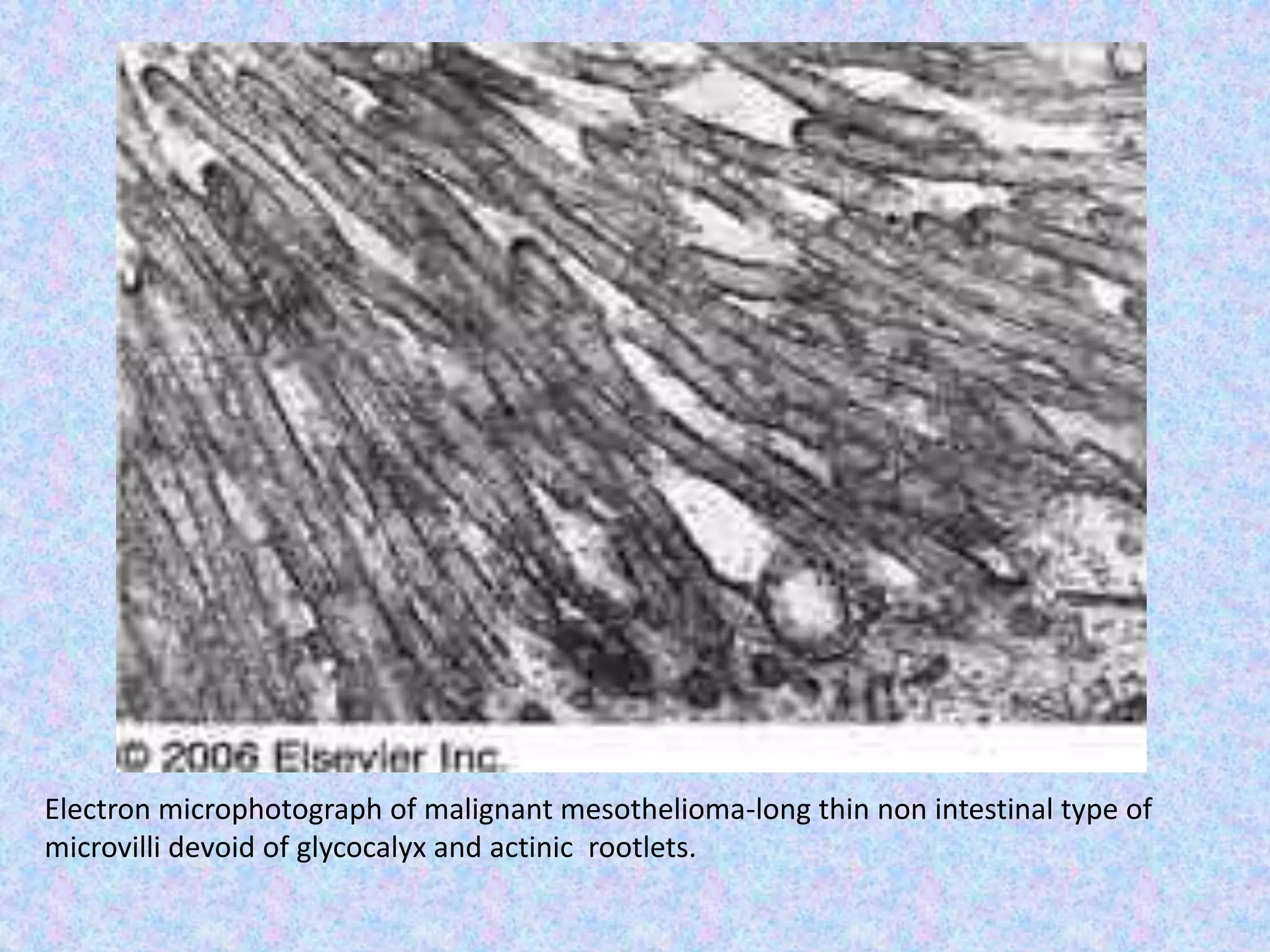 Electron microphotograph of malignant mesothelioma-long thin non intestinal type of
microvilli devoid of glycocalyx and actinic rootlets.
 