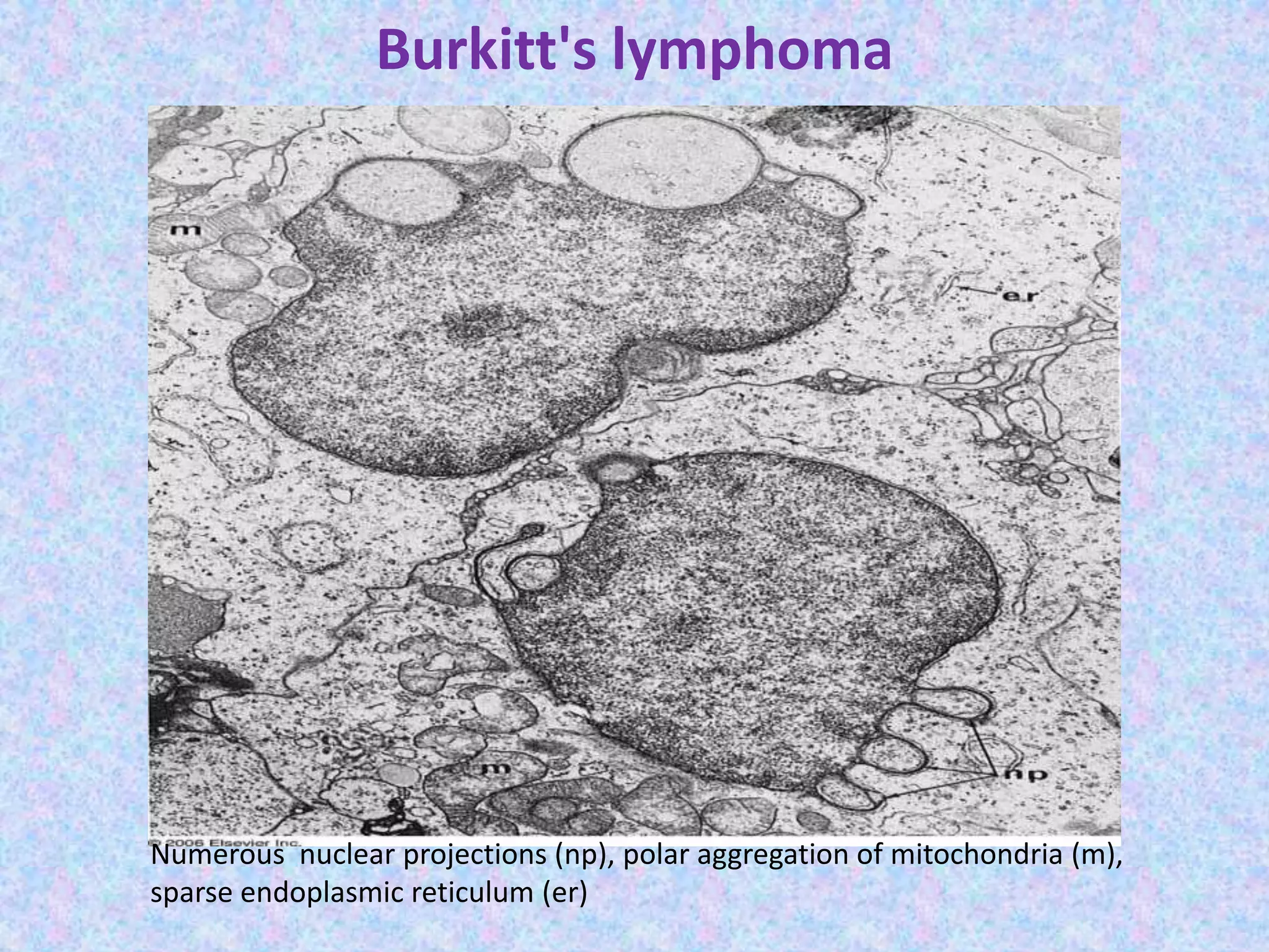 Burkitt's lymphoma




Numerous nuclear projections (np), polar aggregation of mitochondria (m),
sparse endoplasmic reticulum (er)
 