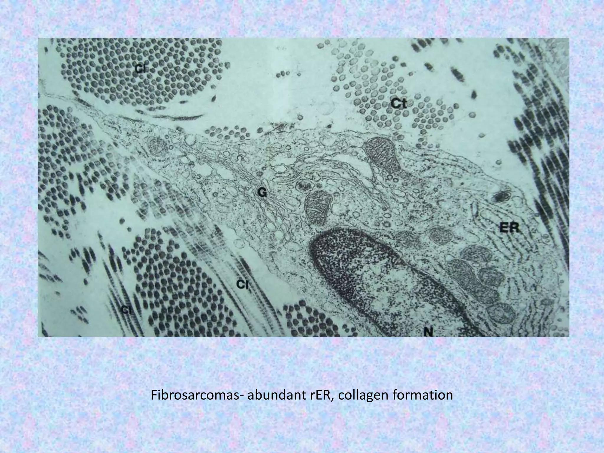 Fibrosarcomas- abundant rER, collagen formation
 