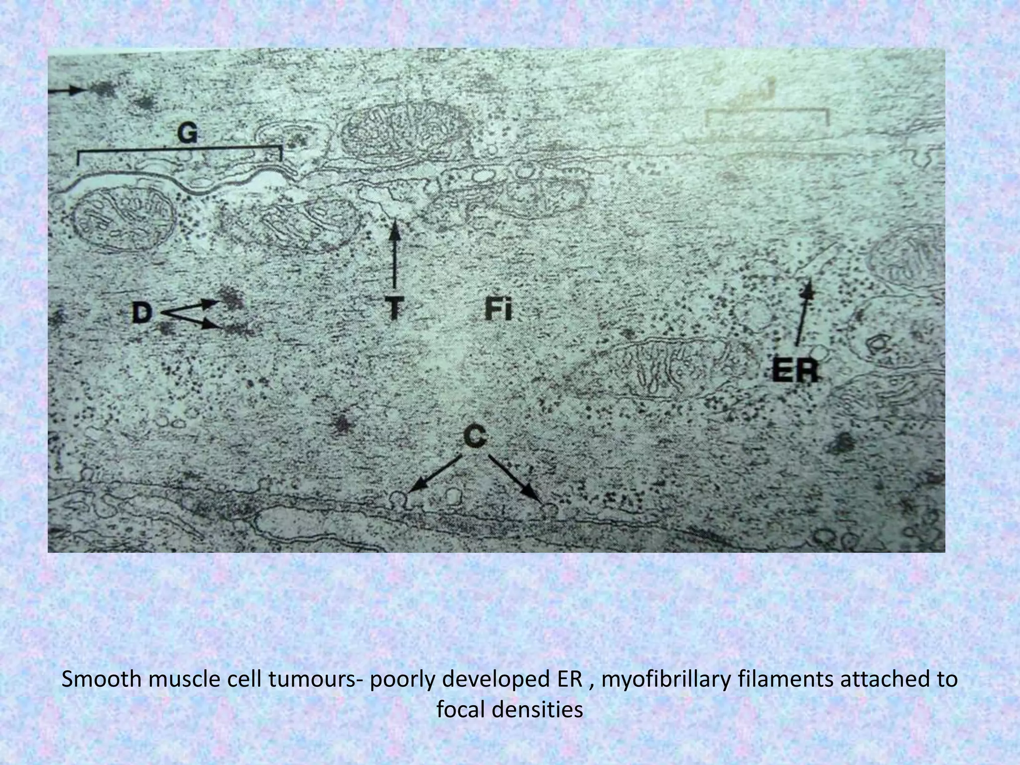 Smooth muscle cell tumours- poorly developed ER , myofibrillary filaments attached to
                                  focal densities
 