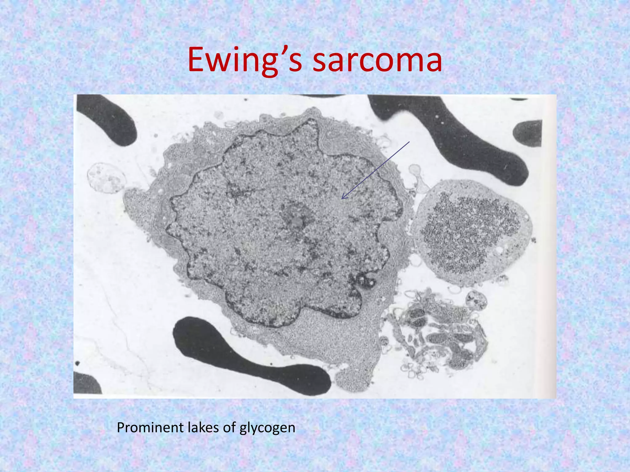 Ewing’s sarcoma




Prominent lakes of glycogen
 