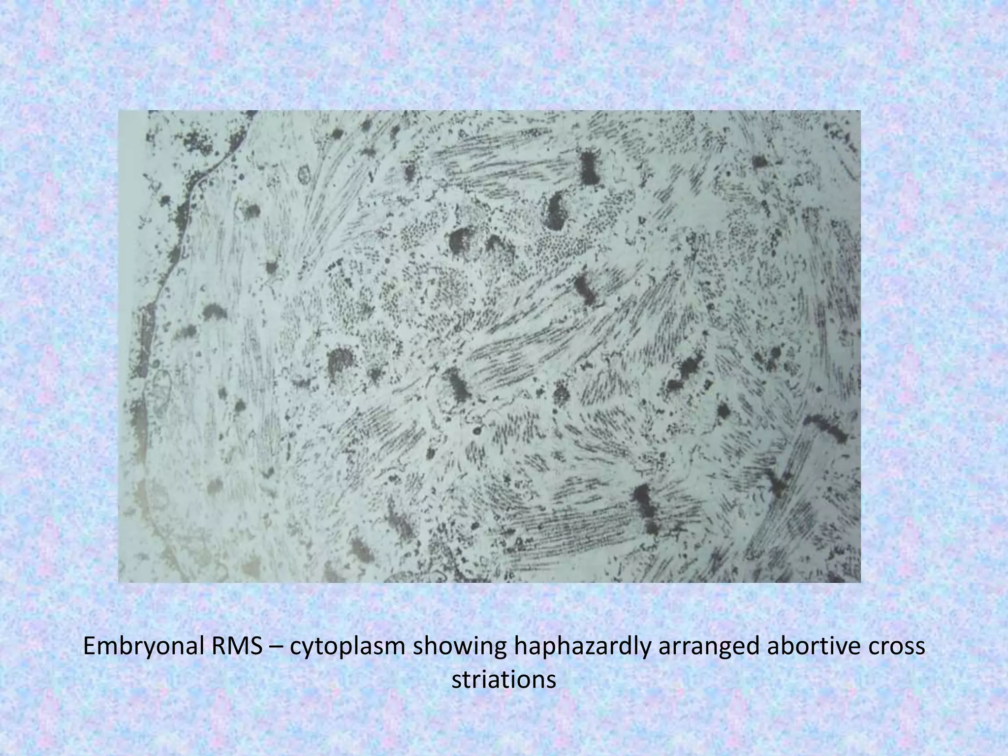 Embryonal RMS – cytoplasm showing haphazardly arranged abortive cross
                             striations
 
