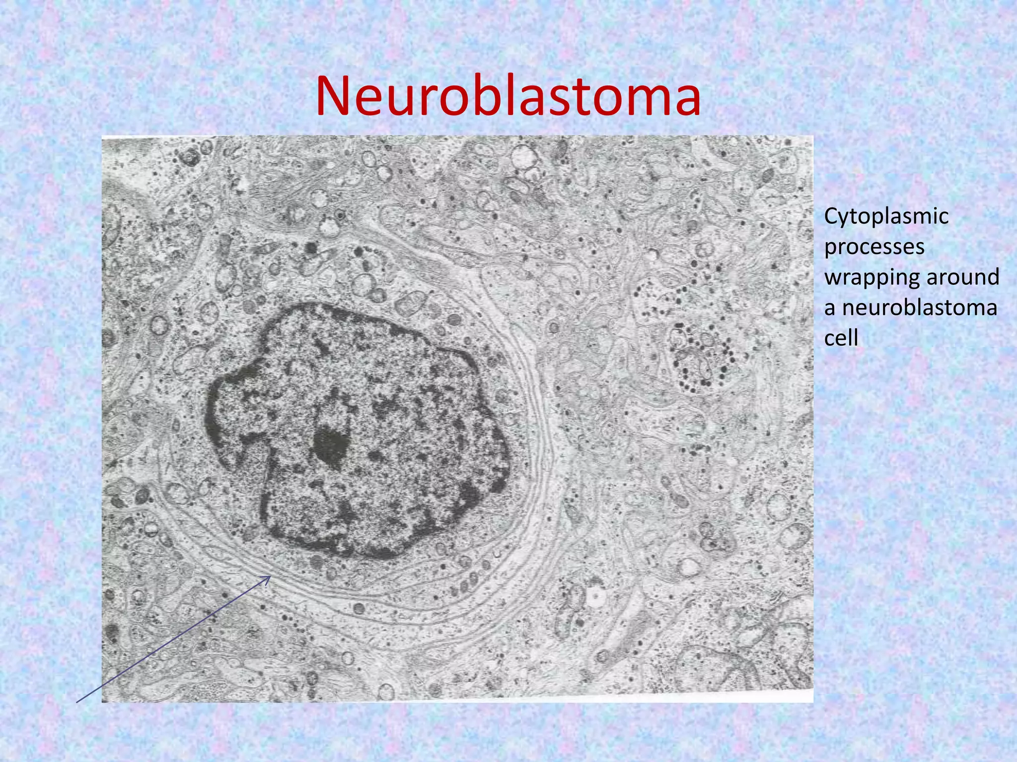 Neuroblastoma
                Cytoplasmic
                processes
                wrapping around
                a neuroblastoma
                cell
 