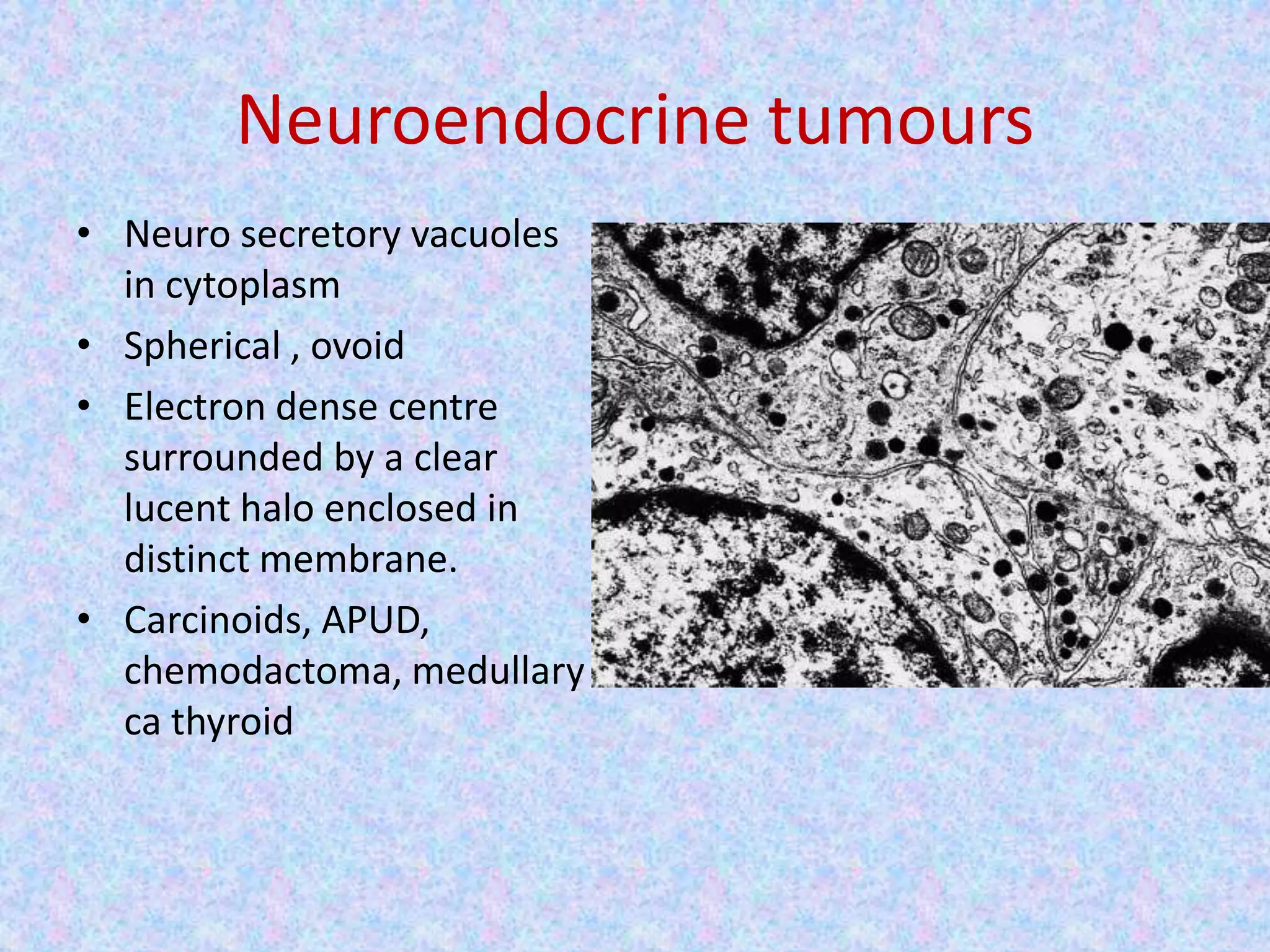 Neuroendocrine tumours
• Neuro secretory vacuoles
  in cytoplasm
• Spherical , ovoid
• Electron dense centre
  surrounded by a clear
  lucent halo enclosed in
  distinct membrane.
• Carcinoids, APUD,
  chemodactoma, medullary
  ca thyroid
 