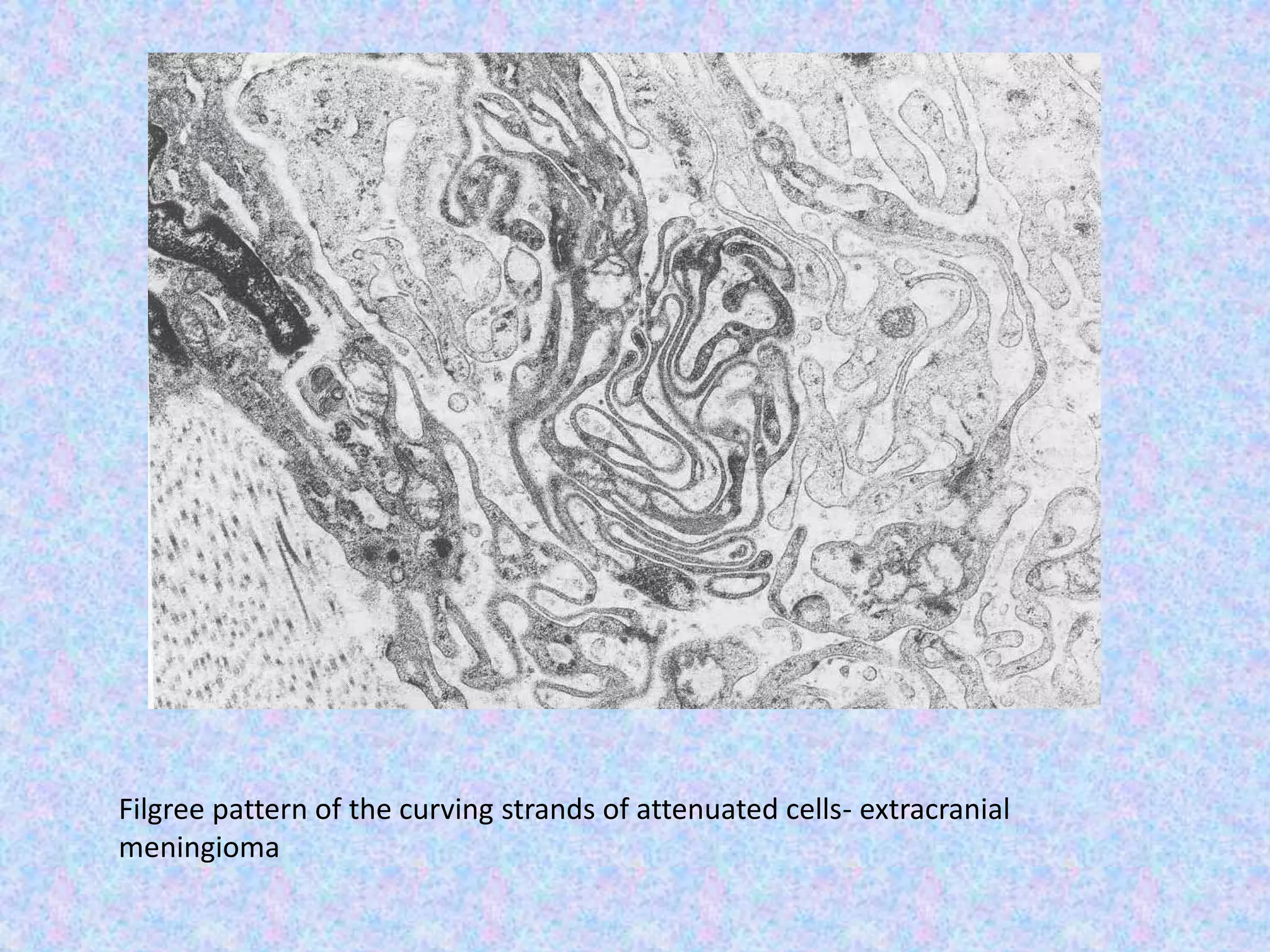 Filgree pattern of the curving strands of attenuated cells- extracranial
meningioma
 