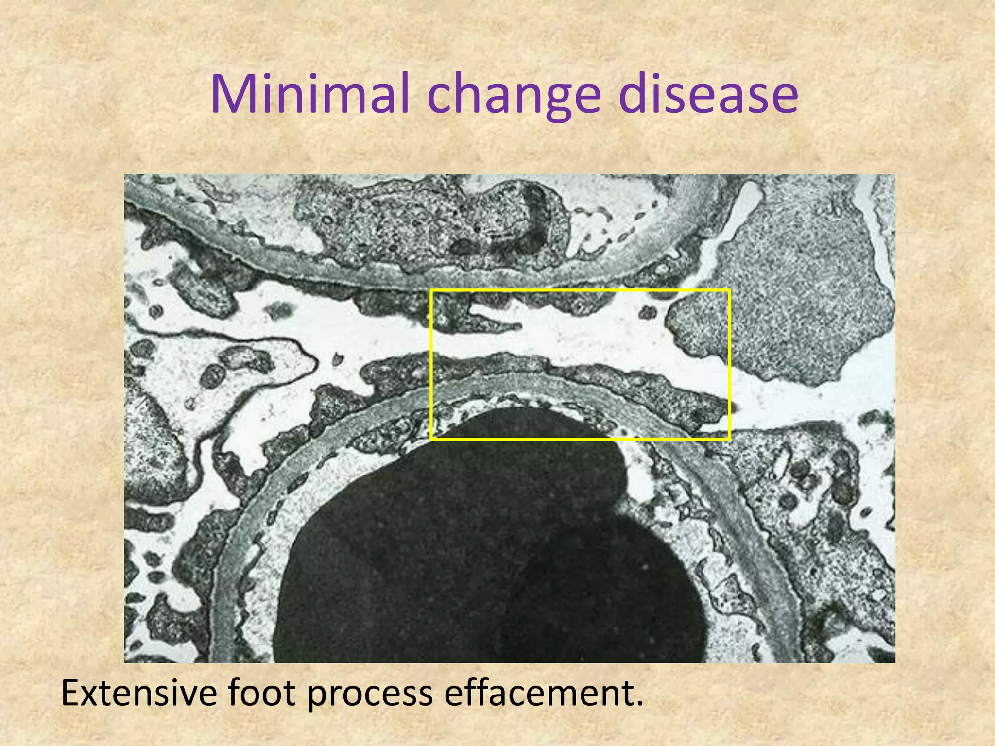 Minimal change disease




Extensive foot process effacement.
 