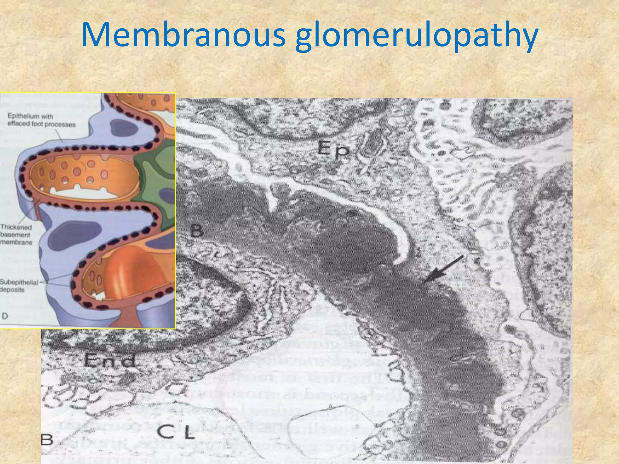 Membranous glomerulopathy
 