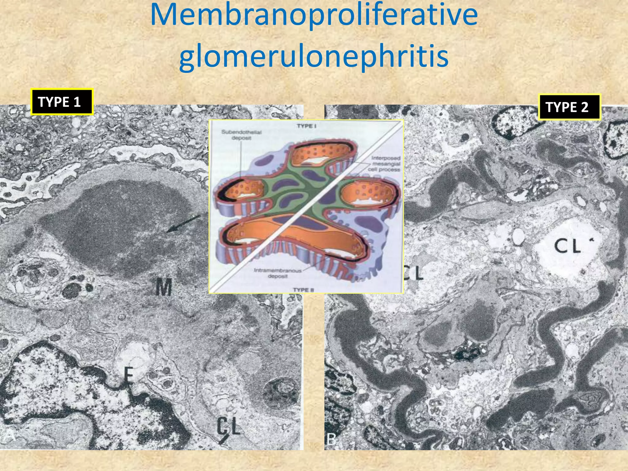 Membranoproliferative
          glomerulonephritis
TYPE 1                           TYPE 2
 