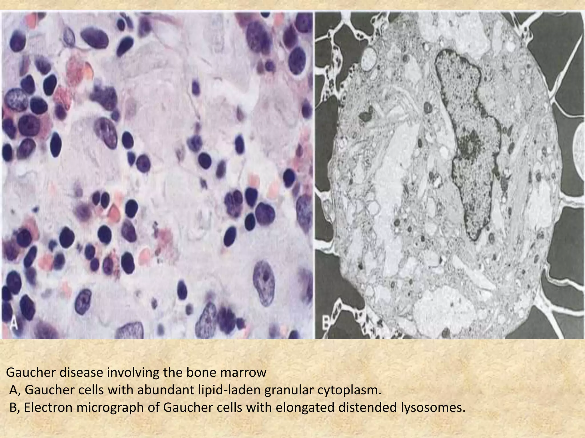 Gaucher disease involving the bone marrow
A, Gaucher cells with abundant lipid-laden granular cytoplasm.
B, Electron micrograph of Gaucher cells with elongated distended lysosomes.
 