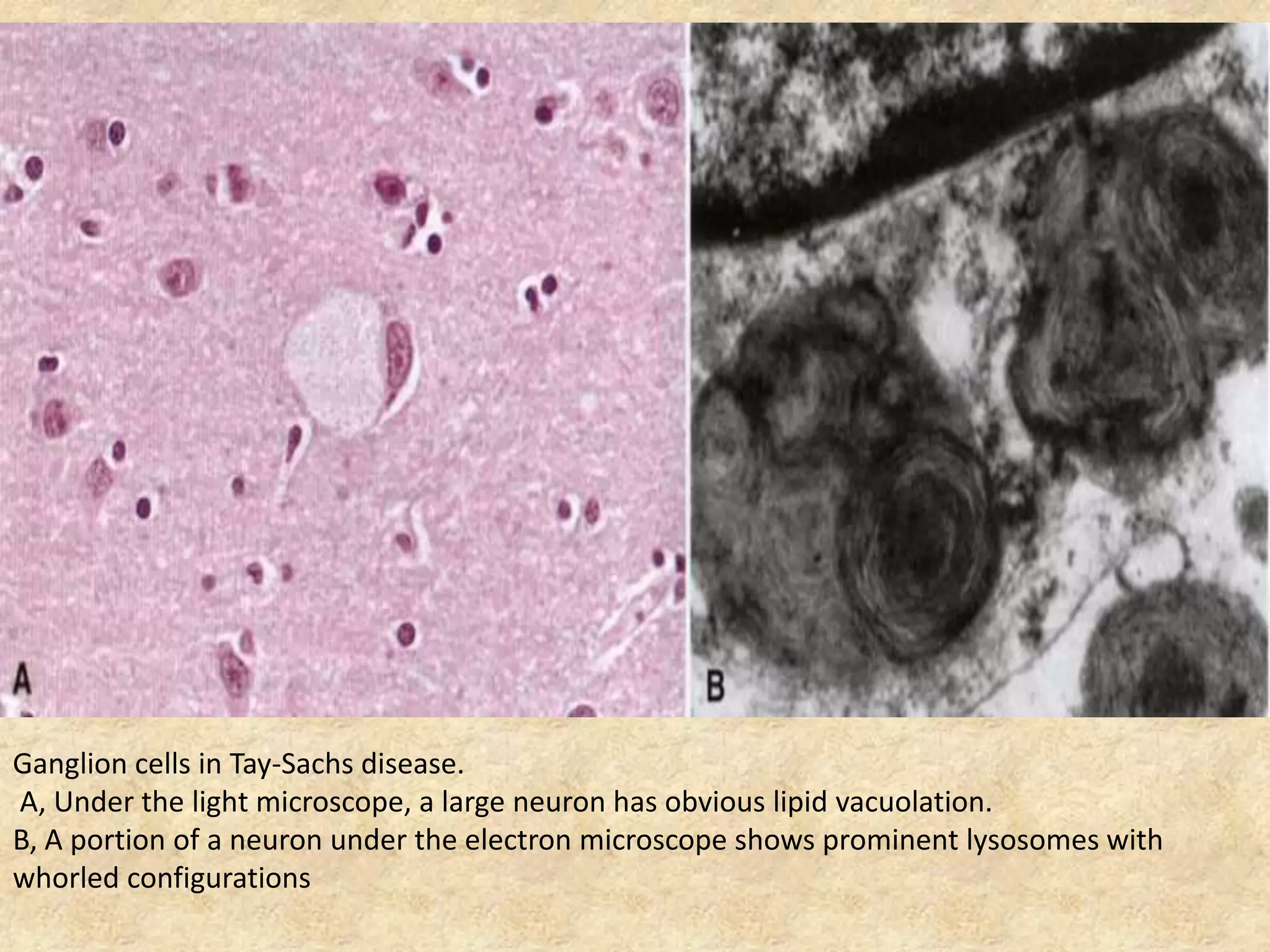 Ganglion cells in Tay-Sachs disease.
A, Under the light microscope, a large neuron has obvious lipid vacuolation.
B, A portion of a neuron under the electron microscope shows prominent lysosomes with
whorled configurations
 