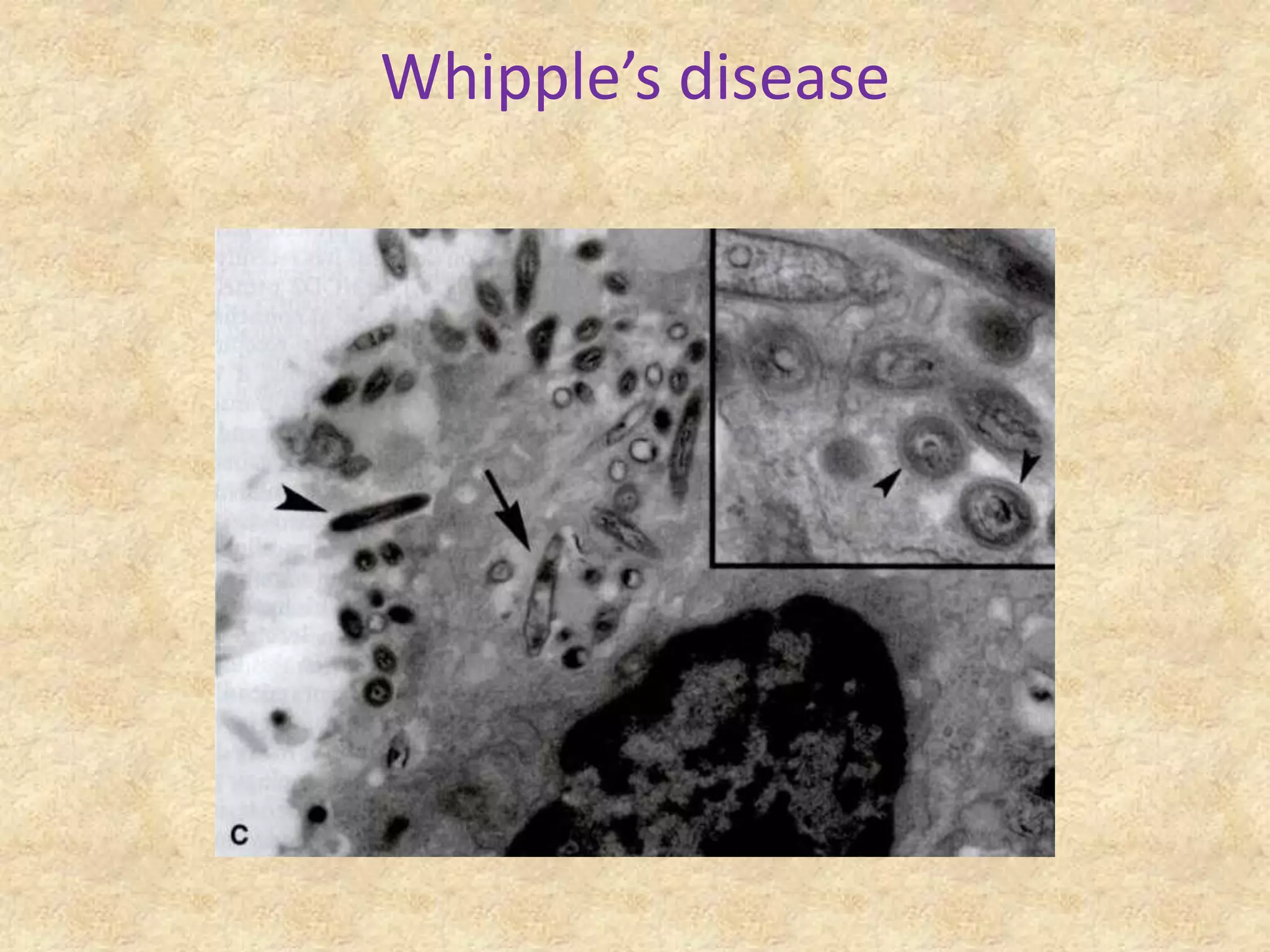 Whipple’s disease
 