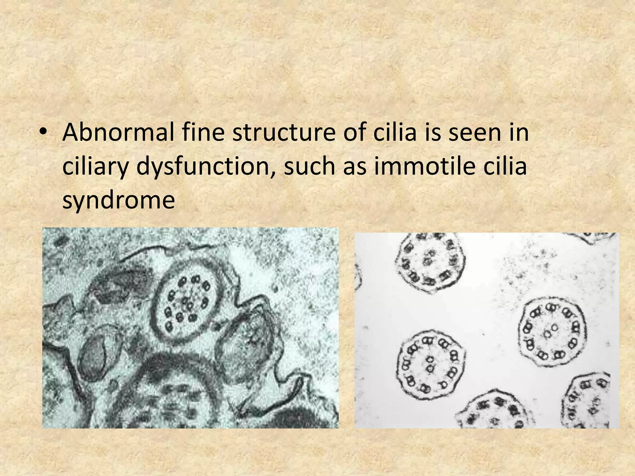 • Abnormal fine structure of cilia is seen in
  ciliary dysfunction, such as immotile cilia
  syndrome
 