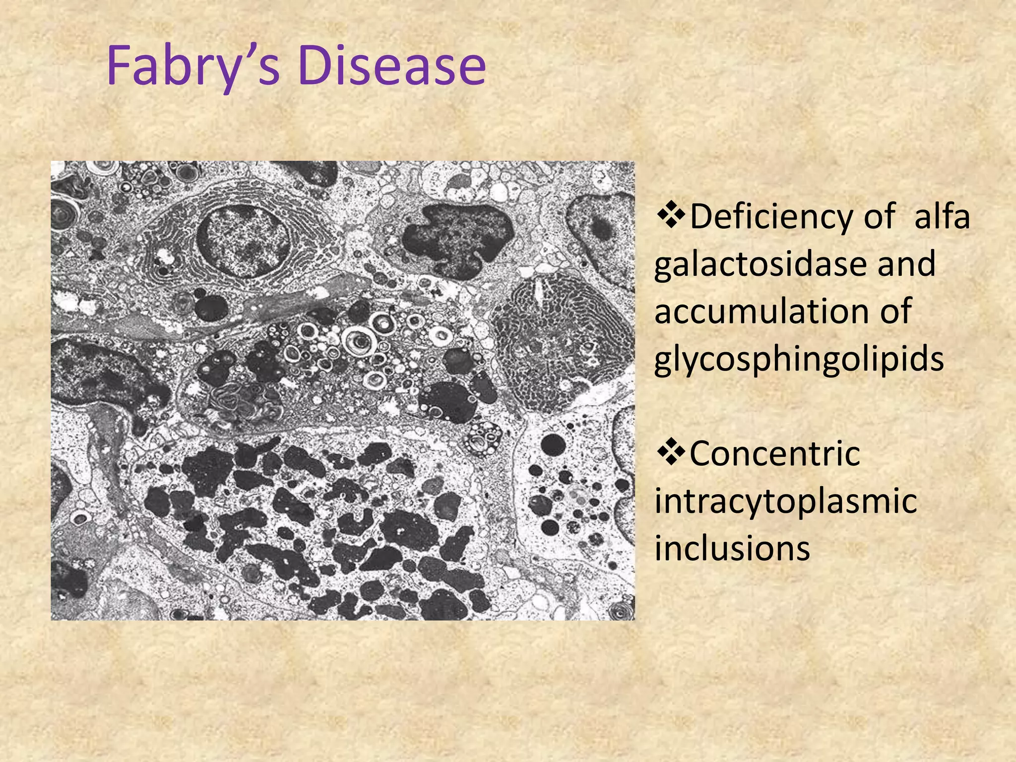Fabry’s Disease

                  Deficiency of alfa
                  galactosidase and
                  accumulation of
                  glycosphingolipids

                  Concentric
                  intracytoplasmic
                  inclusions
 