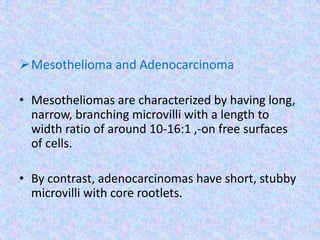 Mesothelioma and Adenocarcinoma

• Mesotheliomas are characterized by having long,
  narrow, branching microvilli with a length to
  width ratio of around 10-16:1 ,-on free surfaces
  of cells.

• By contrast, adenocarcinomas have short, stubby
  microvilli with core rootlets.
 