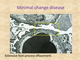 Minimal change disease




Extensive foot process effacement.
 